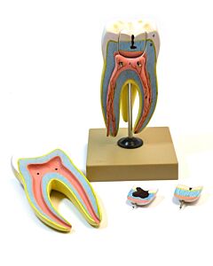 Eisco Labs Human Upper Triple Root Molar With Interchangeable Cavities - 6 Parts